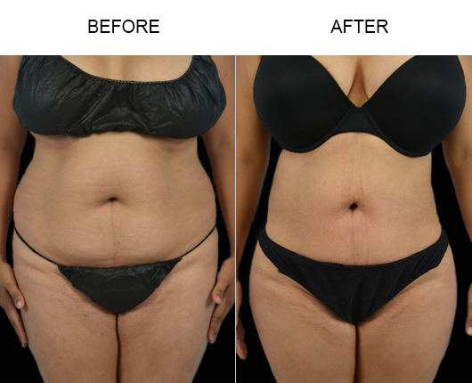 Liposuction Before And After