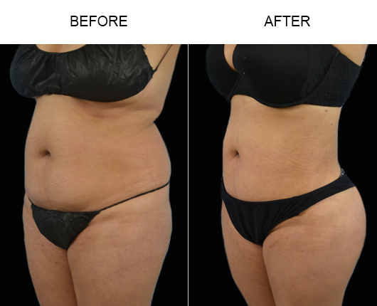 Before And After Liposuction