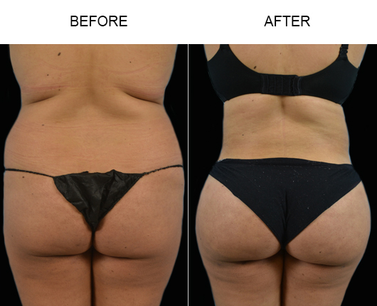 Liposuction Results