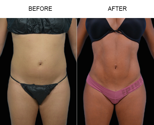 Liposuction Before And After