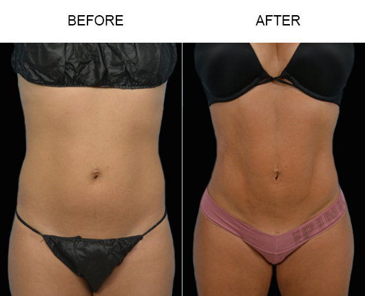 Before And After Liposuction