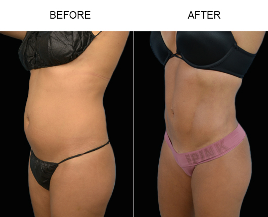 Liposuction Results