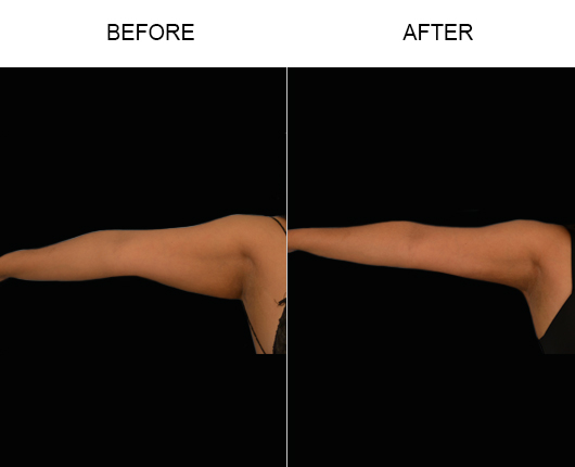 Liposuction Before And After