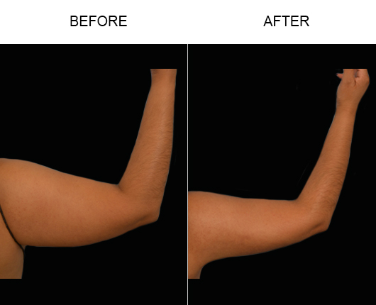 Liposuction Results