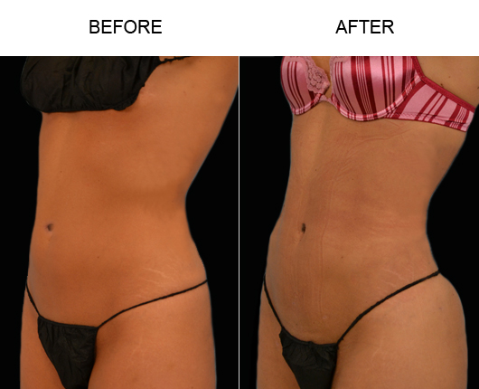 Before And After Liposuction