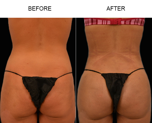 Liposuction Results