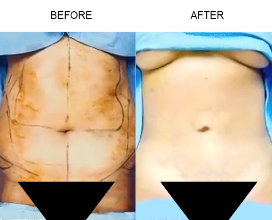 Lipo 360 Before And After