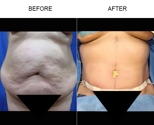 Lipo 360 Before & After