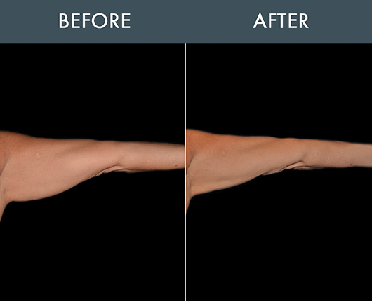 Bodytite Orlando | Radio Frequency Skin Tightening Florida