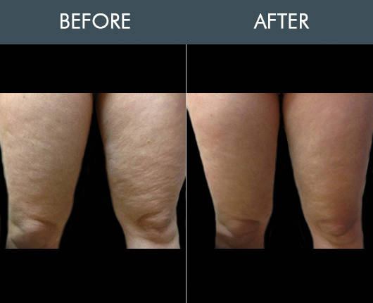 SmartLipo Before and After, Body Jet Orlando, AquaLipo Florida, Smart