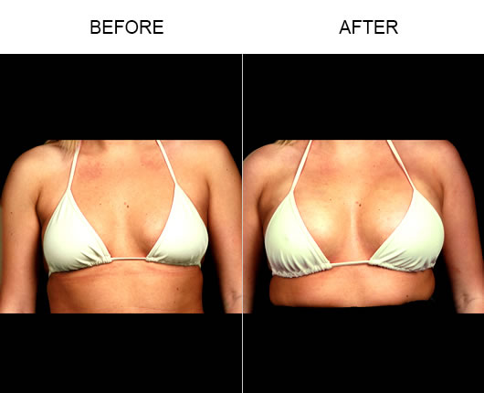 Naturalfill Breast Enhancement Before And After