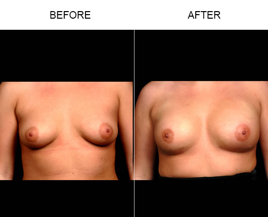Before And After Naturalfill Breast