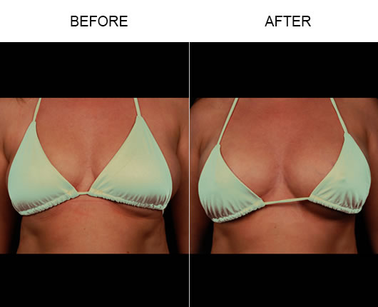 Naturalfill Breast Enhancement Results