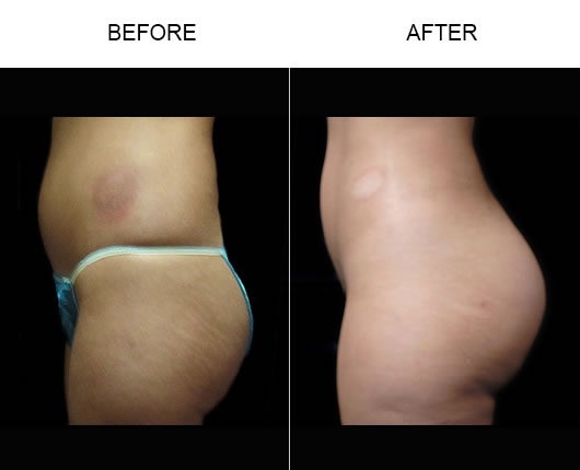 Before And After Naturalfill Buttocks Enhancement