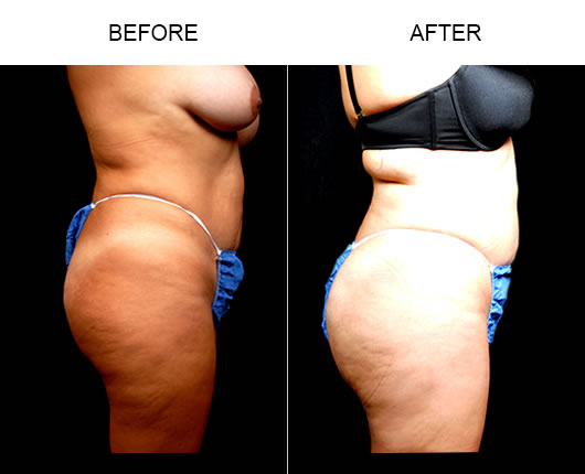 Naturalfill Buttocks Enhancement Before And After