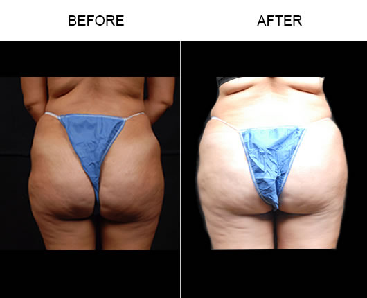 Naturalfill Buttocks Enhancement Results