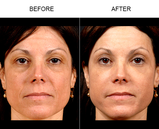 Naturalfill Facial Filler Before And After