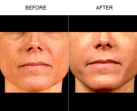 Naturalfill Facial Filler Results