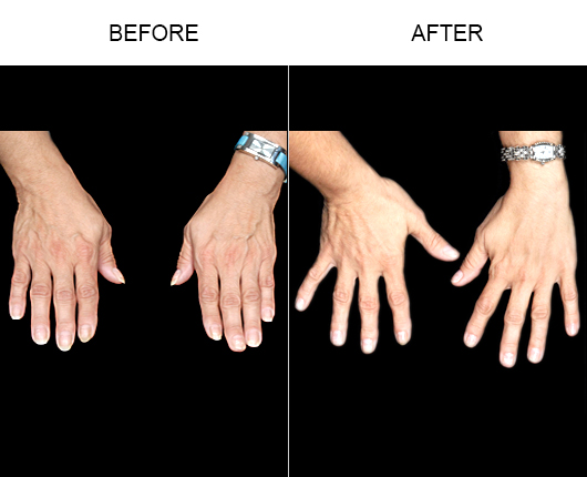 Naturalfill Hand Rejuvenation Before And After
