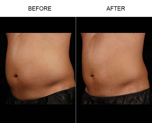 Laser Fat Removal Results