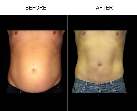 Smartlipo Before And After