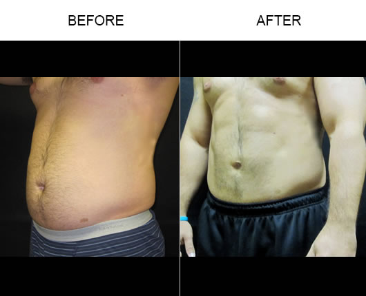 Before And After Smartlipo