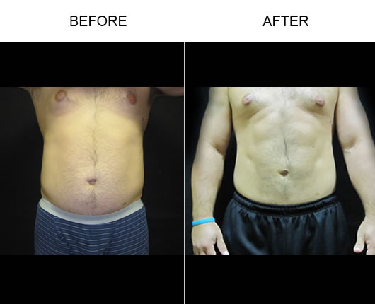 Smartlipo Results