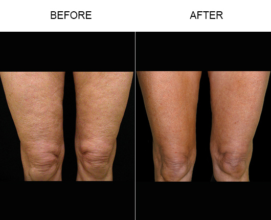 Thermage Body Before And After