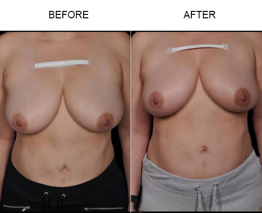 Non-Surgical Breast Lift Before And After