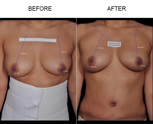 Non-Surgical Breast Lift Before & After