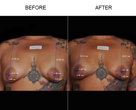 Non-Surgical Breast Lift Results