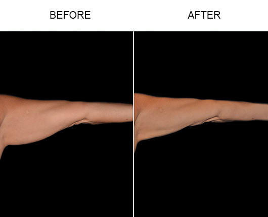 Bodytite Surgery For Arms Results