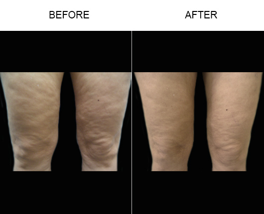 Before & After Bodytite Treatment