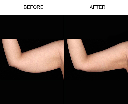 Bodytite For Arms Before And After