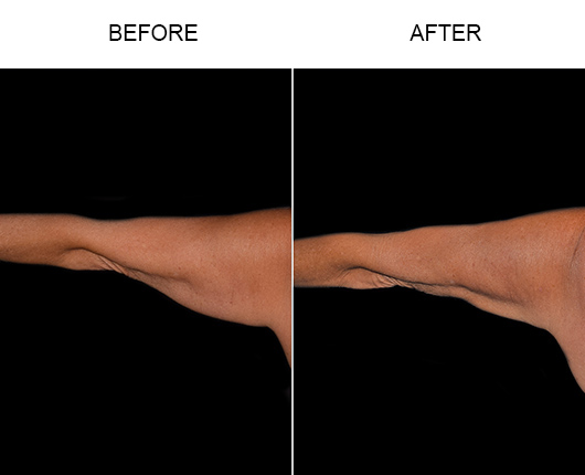 Bodytite For Arms Before & After